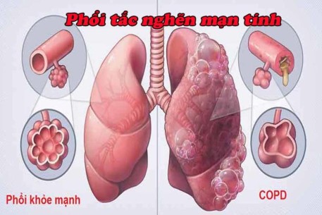 5 thực phẩm tốt cho người bệnh phổi tắc nghẽn mạn tính (COPD)