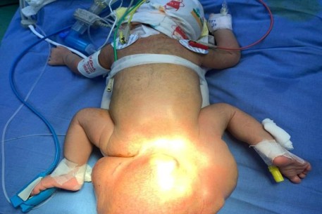 Bệnh viện Phụ sản – Nhi Đà Nẵng phẫu thuật thành công khối u hơn 1,2kg vùng cụt ở bé gái 5 ngày tuổi