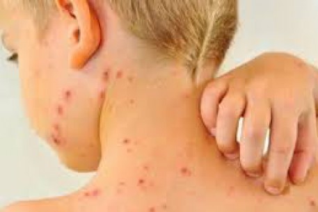 Hà Nội triển khai đồng loạt chiến dịch tiêm bổ sung vắc xin sởi – rubella miễn phí