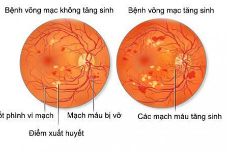 CÁCH NHẬN BIẾT CÁC BIẾN CHỨNG Ở MẮT  CỦA BỆNH TIỂU ĐƯỜNG