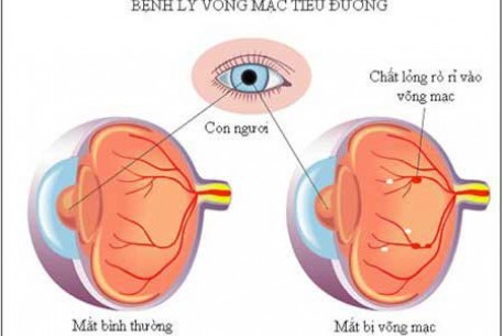 NHỮNG AI CÓ NGUY CƠ MẮC BỆNH VÕNG MẠC ĐÁI THÁO ĐƯỜNG?