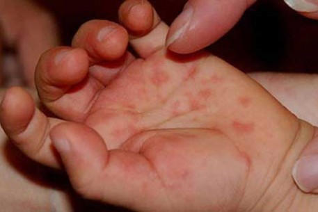 BỘ Y TẾ KHUYẾN CÁO PHÒNG BỆNH TAY CHÂN MIỆNG