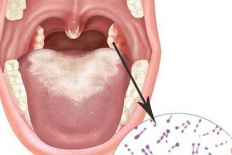 DỰ PHỒNG BỆNH BẠCH HẦU