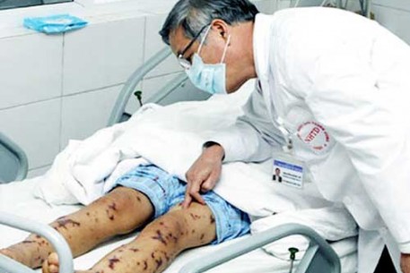BỆNH LIÊN CẦU LỢN