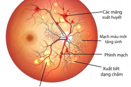 CÁCH ĐIỀU TRỊ BIẾN CHỨNG MẮT CỦA BỆNH TIỂU ĐƯỜNG