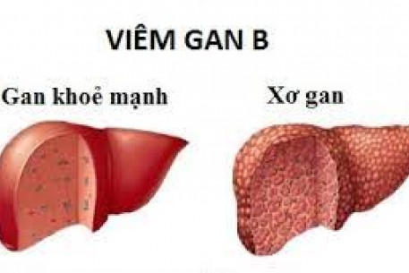 NHỮNG ĐIỀU CẦN BIẾT VỀ BỆNH VIÊM GAN SIÊU VI B