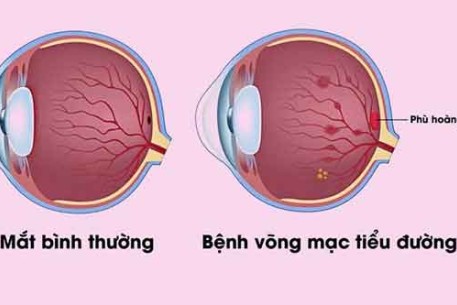 BIẾN CHỨNG MẮT CỦA BỆNH ĐÁI THÁO ĐƯỜNG: DẤU HIỆU NHẬN BIẾT