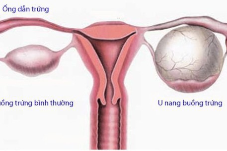 7 cách dự phòng ung thư buồng trứng