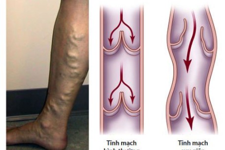 Dự phòng và điều trị bệnh giãn tĩnh mạch