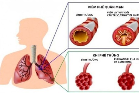 Những điều cần biết về bệnh phổi tắc nghẽn mãn tính