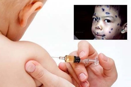 Tiêm vắc xin - biện pháp đơn giản, hiệu quả trong phòng ngừa bệnh Thủy đậu