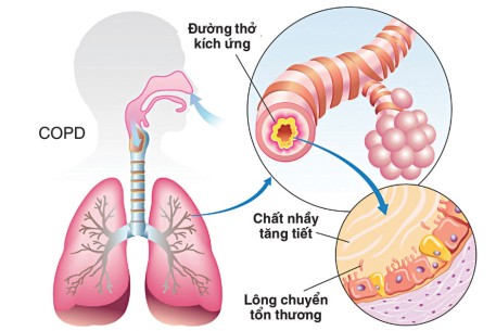 Bệnh Phổi tắc nghẽn mạn tính và cách phòng ngừa hiệu quả