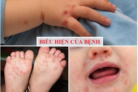 Bệnh Tay chân miệng – phòng bệnh được ưu tiên hàng đầu