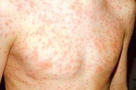 Bệnh Sởi – nguy cơ ở trẻ lớn và người trưởng thành