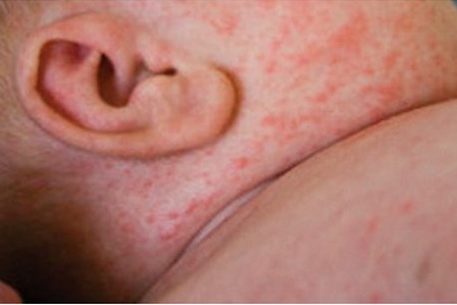Cảnh báo gia tăng bệnh Sởi ở người lớn và trẻ dưới 9 tháng tuổi