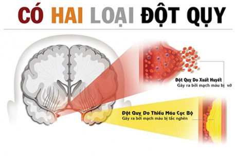 CẤP CỨU ĐỘT QUỴ: SỰ SỐNG TÍNH TRONG TỪNG PHÚT GIÂY