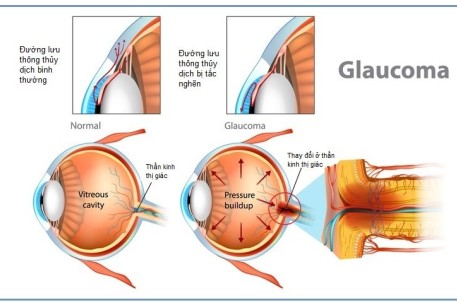 Glôcôm: Kẻ đánh cắp thị lực thầm lặng