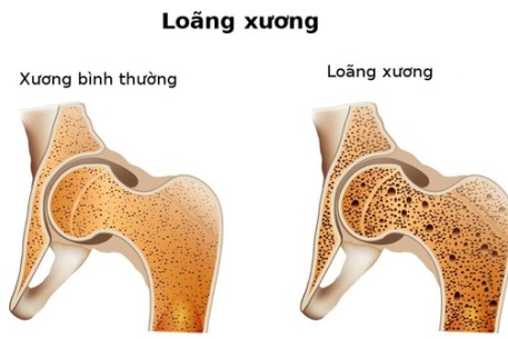 Vai trò của canxi và cách bổ sung an toàn, hiệu quả