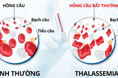 Tan máu bẩm sinh (thalassemia) là gì và phòng bệnh như thế nào?