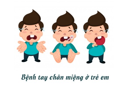 Không chủ quan với bệnh tay chân miệng