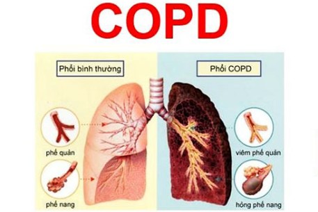 Nhiệt độ môi trường thay đổi rất dễ bùng phát các đợt cấp của Bệnh phổi tắc nghẽn mạn tính