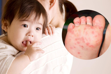 Hè đến rồi, phụ huynh cần chú ý phòng bệnh mùa nắng nóng cho trẻ