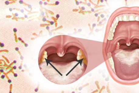 Bệnh Bạch hầu và các biện pháp phòng bệnh