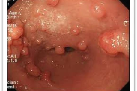 Những điều cần biết về bệnh Polyp túi mật