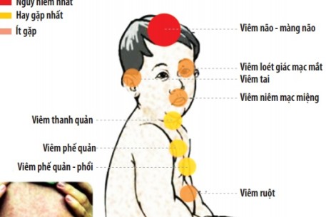 Các biến chứng của bệnh Sởi và cách phòng tránh