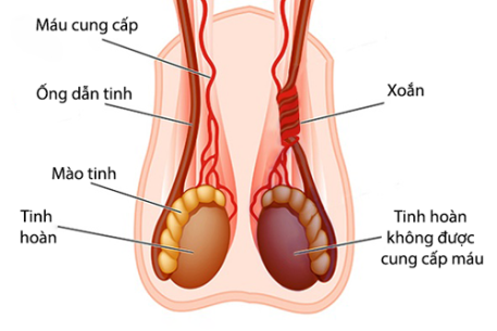 Đau bìu cấp - hãy cảnh giác với xoắn tinh hoàn ở trẻ em