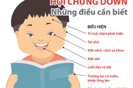 Bệnh Down: Triệu chứng, các yếu tố nguy cơ và biện pháp ngăn ngừa