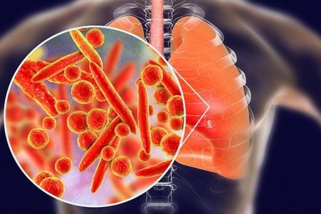 Bộ Y tế thông tin nhanh về các trường hợp mắc bệnh chưa rõ nguyên nhân  tại Liên bang Nga