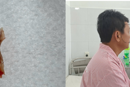 Ho kéo dài, coi chừng dị vật đường thở