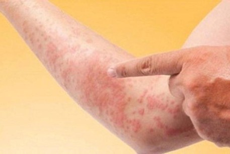 Dị ứng hải sản - một số điều cần biết