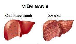 NHỮNG ĐIỀU CẦN BIẾT VỀ BỆNH VIÊM GAN SIÊU VI B
