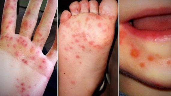 PHÒNG NGỪA BỆNH TAY CHÂN MIỆNG Ở TRẺ