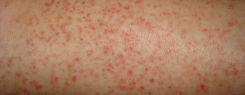 các vết xuất huyết dưới da 