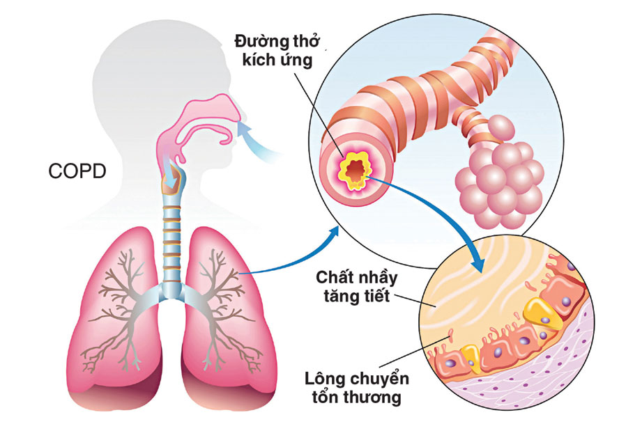 COPD