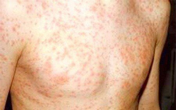 bệnh sởi người lớn