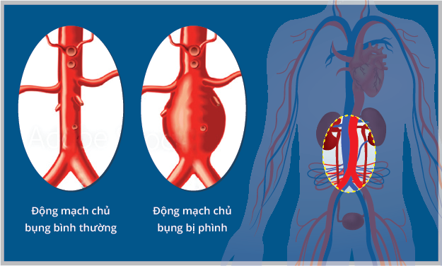 ĐMC Bụng