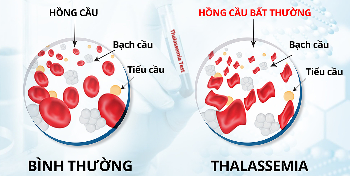 bệnh tan máu bẩm sinh