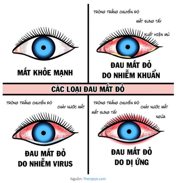 đau mắt đỏ