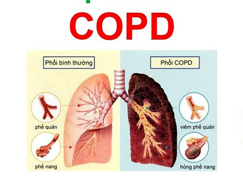 COPD