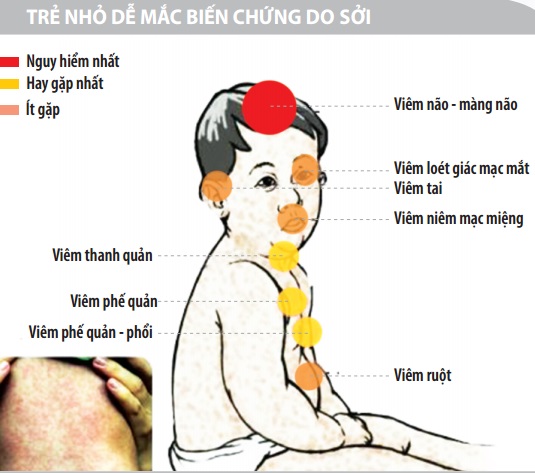 biến chứng bệnh Sởi