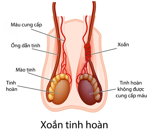 xoắn tinh hoàn