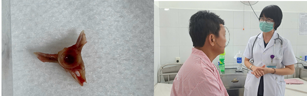 dị vật đường thở